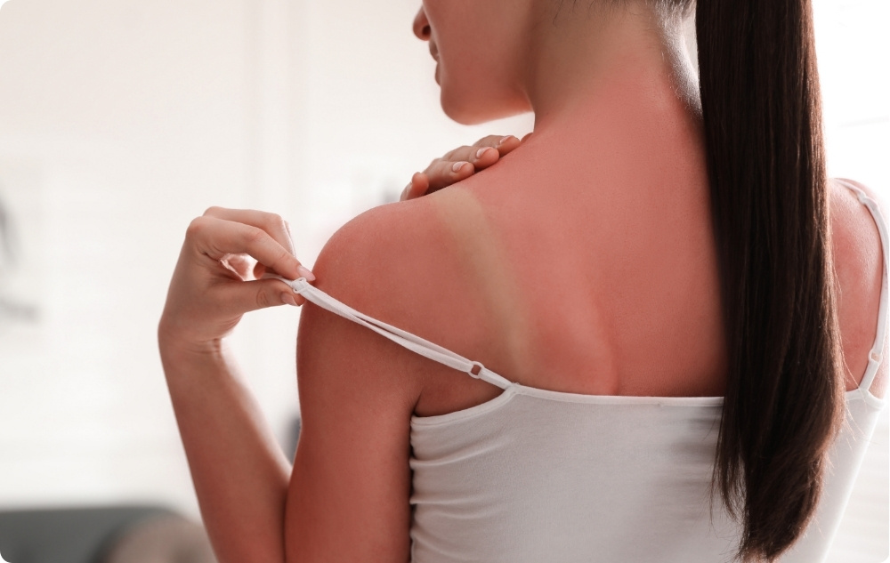 Als verzachtende aftersunlotion